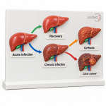 Typical Course of Hepatitis B Virus Acute Chronic Model